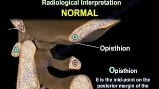 Occipitocervical Dislocation - Everything You Need To Know - Dr. Nabil Ebraheim