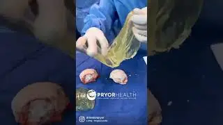 Breast Implant Removal at PryorHealth in Rockford, IL