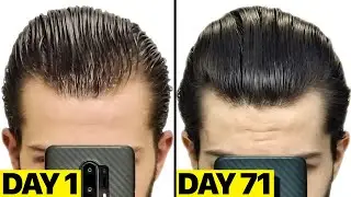 My INSANE Finasteride & Minoxidil 2.5 Months Results