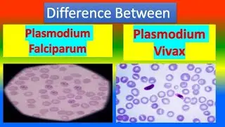 Distinction Between Plasmodium Falciparum and Plasmodium Vivax