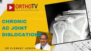 AC Joint Reconstruction by Dr Clement Joseph