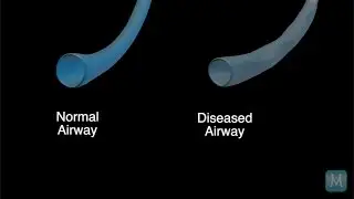 What Is COPD (Chronic Obstructive Pulmonary Disease)? Part 2 | Match Health