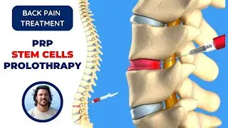 🔺 Stem Cell Therapy, PRP, Prolotherapy for Back Pain Relief, Treatment that Works