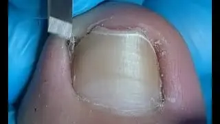 Satisfying! How to repair ingrown toenail!