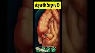 Appendix surgery 3D Animation 