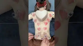 [ASMR] A Giant Heart - Cupping Therapy 