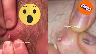 The Ultimate Pimple Popping Compilation: Prepare to be Amazed!