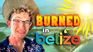 Horrible SUNBURNS from Belize!