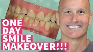 New Teeth in One Day Smile Makeover with Dental Veneers and Crowns