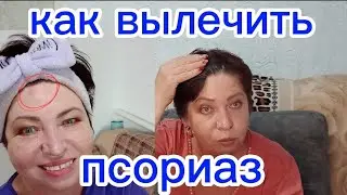 Я как умная Маша решила выйти в ПРЯМОЙ Эфир...НЕ ПУСТИЛИ)))Как я Вылечила ПСОРИАЗ за МЕСЯЦ?!