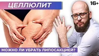 Можно ли убрать целлюлит с помощью липосакции? Что такое целлюлит? Апельсиновая корка