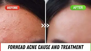 Forehead Acne Causes And Treatment || Quick Tips If You Have FOREHEAD ACNE || Dr. Anvika