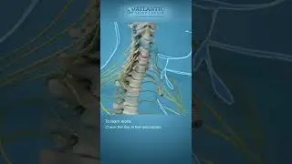 What is Endoscopic Anterior Cervical Discectomy? #Shorts