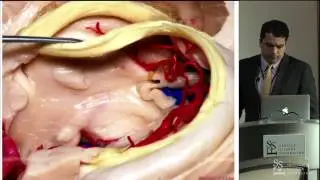 Approaches to the Third Ventricle Interhemispheric Transcallosal by Christian Bowers, M.D.