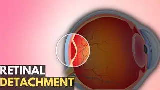 Retinal Detachment: Everything You Need To Know