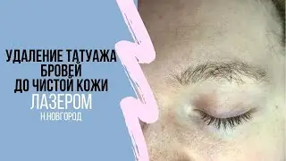 УДАЛЕНИЕ ТАТУАЖА БРОВЕЙ ДО ЧИСТОЙ КОЖИ, ДО и ПОСЛЕ. Н.НОВГОРОД