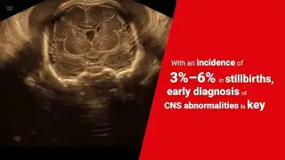 Topic in Spotlight - Fetal Brain and Central Nervous System (CNS)