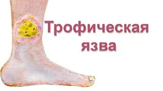 Трофическая язва