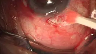 Trabeculectomy for treatment of glaucoma. Edited. Surgery Pearls. San Antonio, TX.