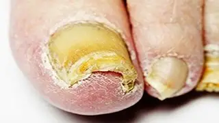 Nail Fungus Treatment - Home Remedy for Nail Fungus That Actually Works