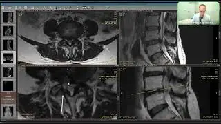 Изменения на МРТ позвоночника за 10 лет. Разбор реального клинического случая