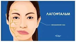 ЛАГОФТАЛЬМ: не закрываются глаза, что делать?