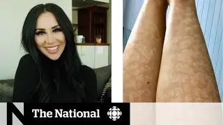 Laser hair removal leaves woman with intense scarring