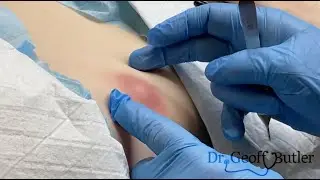 Drainage and likely removal of an infected epidermal cyst