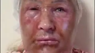 Вся правда о феноловом пилинге. Видео до/после! Тем,кто не верил смотреть до конца 