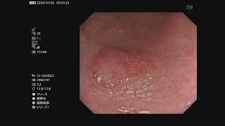 Surveillance colonoscopy using TXI, NBI, Indigo Carmine and Endocytoscopy