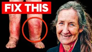 15 Years of Swollen Legs & Feet Gone in Minutes! Barbara ONeills HIDDEN Discovery