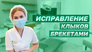 Исправление клыков брекетами - тяжелый случай? Подготовка к брекетам Сочи. Magic Dent