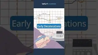 Early Decelerations Explained 🩺 #NursingStudents #FetalMonitoring