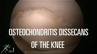 Osteochondritis dissecans of the knee: Treatment options for this challenging knee injury