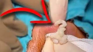 Yüzünden bıldırcın yumurtası çıkardım! SEBACEOUS CYST POPPER