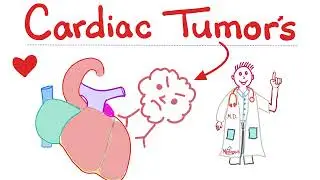 Heart Tumors - Myxoma, Rhabdomyoma, Leiomyosarcoma -  Cardiology Playlist