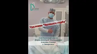 Удаление "Вдовьего горба" - липосакция горба.