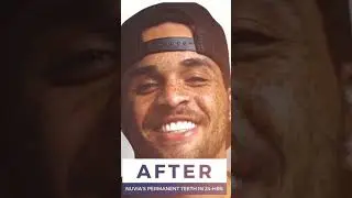 Smile Transformation Has AMAZING Results! 🤩 Just Wait! 🤯 #shorts