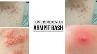 Can Armpit Rash Cause Other Complications?