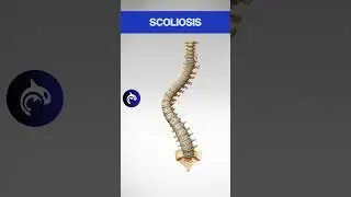 Scoliosis in 3D: Abnormal Sideways Curvature of the Spine 