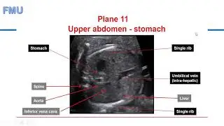 Fetal Ascites - Dr C. Gwanzura