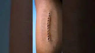 How Stitches Work 😯