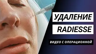 УДАЛЕНИЕ RADIESSE 📢 | УДАЛЕНИЕ ФИЛЛЕРА ХИРУРГИЧЕСКИМ ПУТЕМ | ПЛАСТИКА НИЖНИХ ВЕК | ВИДЕО С ОПЕРАЦИИ