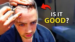 I Finally Got a Hair Transplant... | Hair Surgeon Reacts