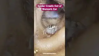 Spider Crawls Out of Woman’s Ear 🕷 DOCTOR REACTS! 