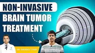 Painless & Scarless:  ZAP - X Radiosurgery Successful Treatment By Dr. Gaurav Tyagi