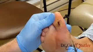 Debridement of a diabetic toe ulcer