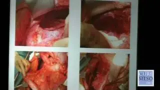 Peritoneal Mesothelioma Resource - Dr. James F. Pingpank