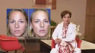 O botox ajuda você a envelhecer melhor.