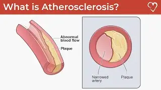 What is Atherosclerosis?